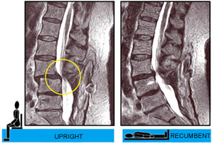 Upright MRI vs. Recumbent MRI